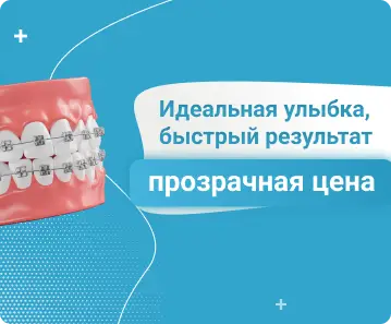 Установка брекетов - Идеальная улыбка, быстрый результат