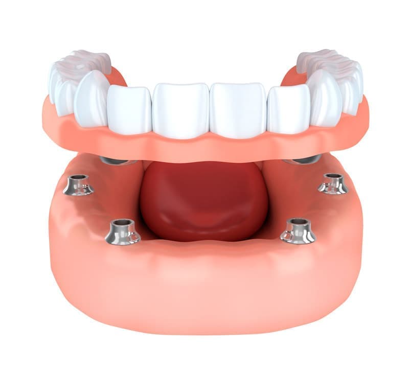 Несъемный протез All-on-4: тип протезирования, когда искусственный зубной ряд устанавливается на 4 импланта.