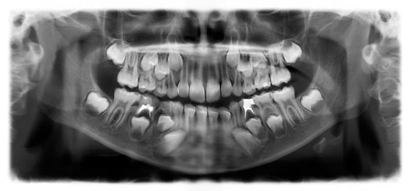 На рентген-снимке: молочные и прорезывающиеся зубы 7-летнего ребенка.