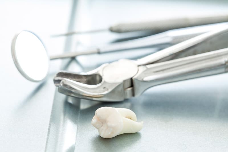 Удаление зуба: степень сложности операции (и, соответственно, цена) зависит от кривизны корней зуба, разрушенности и положения в зубном ряду.