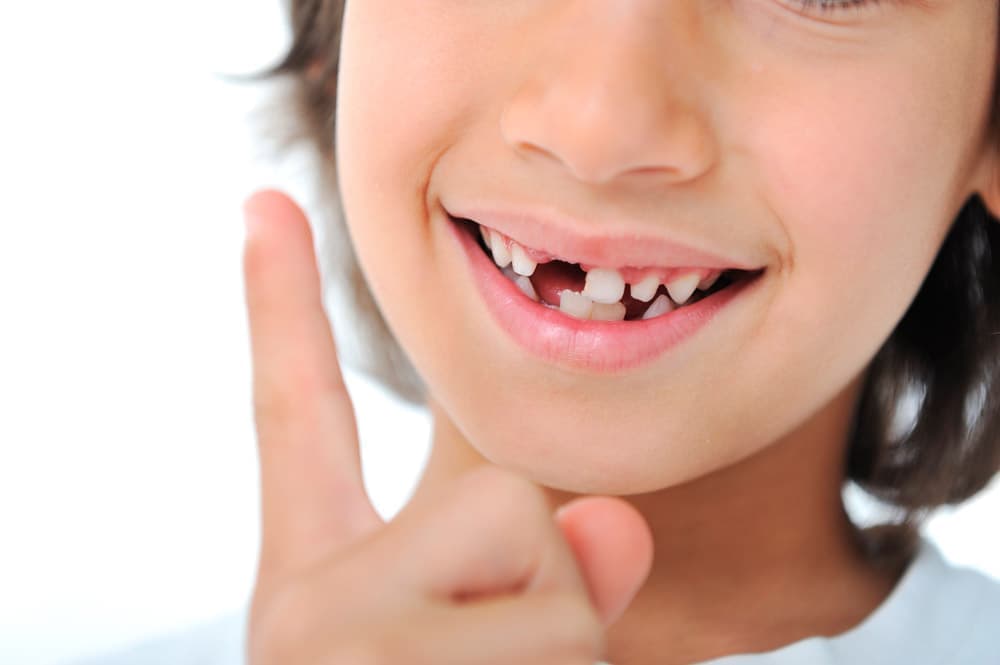 Молочные зубки лучше удалять не самостоятельно, а у стоматолога.