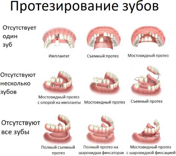 Виды протезирования