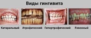 Лечение гингивита