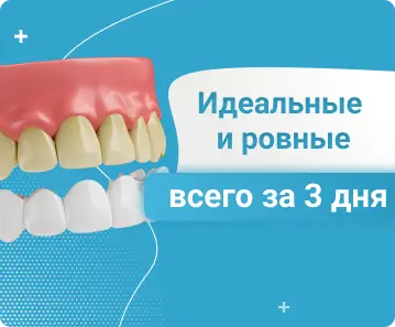 Виниры - Идиальные и ровные всего за 3 дня